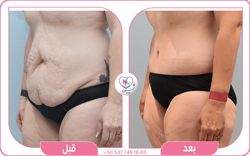 اختاري تركيا لاكشري كلينك لنحت الجسم قبل وبعد