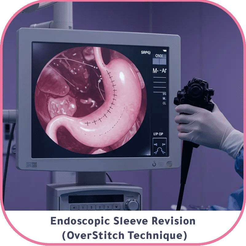 Can You Get Gastric Sleeve Twice? Best Revision Options Turkey 2025