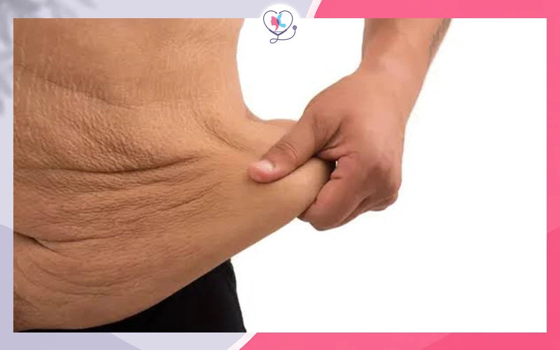 ترهلات الجلد الشديدة