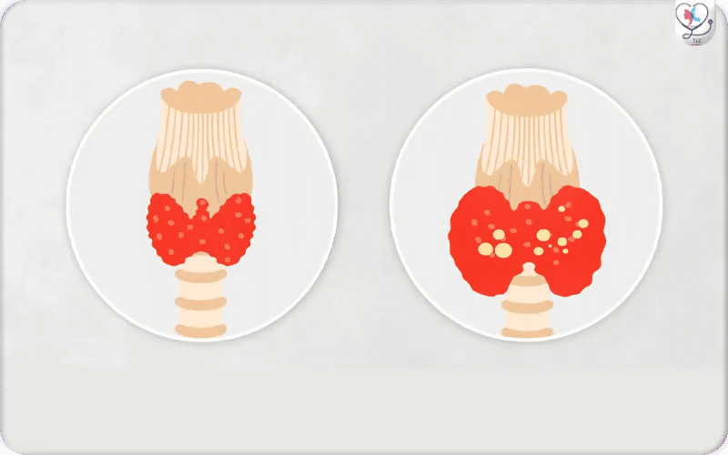 ما هو علاج تضخم الغدة الدرقية؟