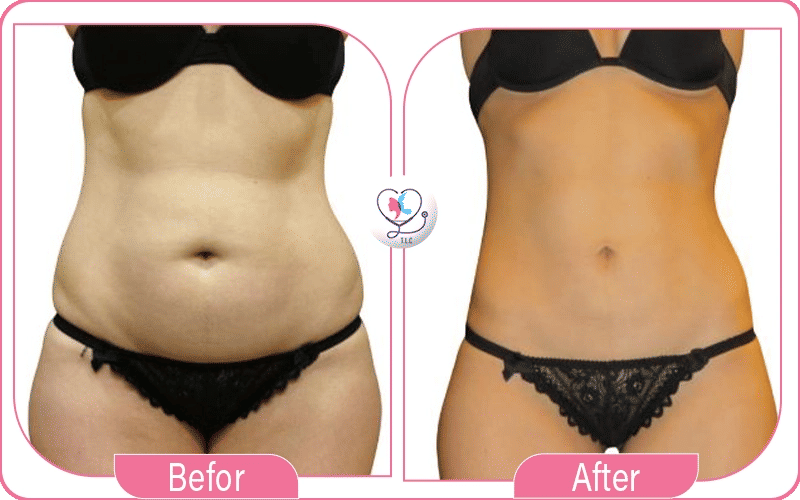 Is Lipo 360 Dangerous?