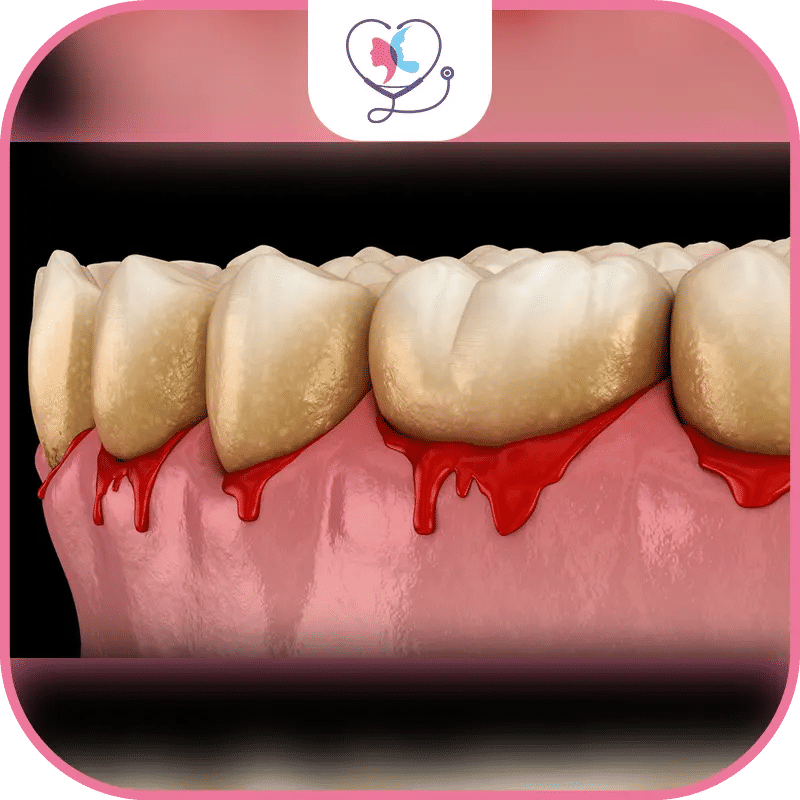 ما هي درجات التهاب اللثة؟