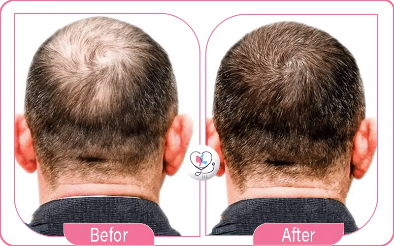 تجربتي مع أمبولات الخلايا الجذعية للشعر تجربتي مع أمبولات الخلايا الجذعية للشعر