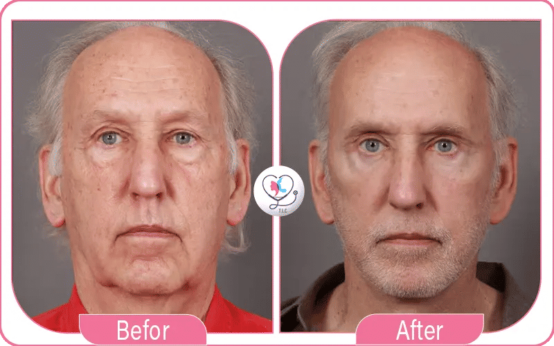 Qu’est-ce qu’un mini lifting du visage ?-2