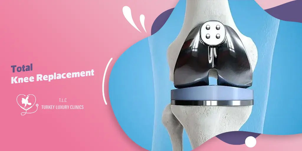 Artroplastia de Rodilla: Procedimiento de Reemplazo Total