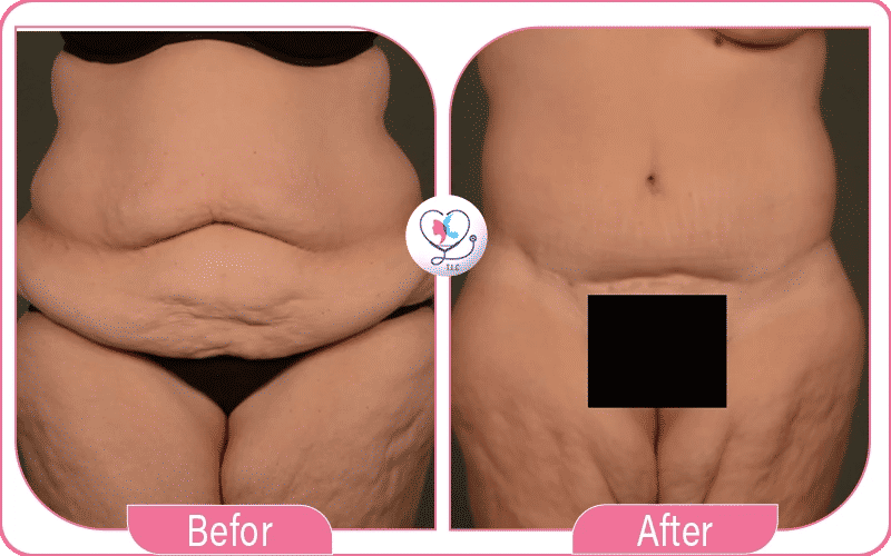 Abdominal Swelling 3 Weeks After Tummy Tuck Pictures