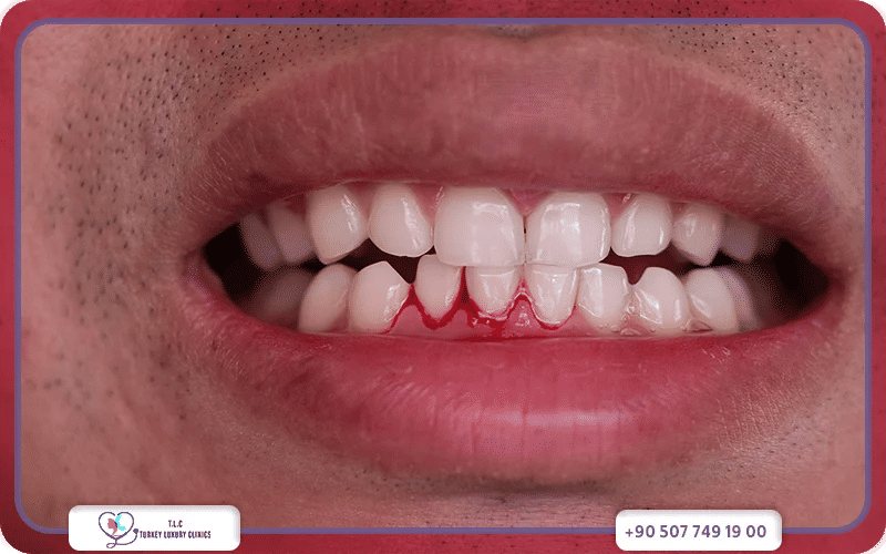 نزيف اللثة: الأسباب والأعراض وطرق العلاج الطبية والدوائية-1772049183177