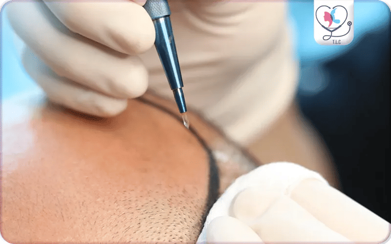 What is a Sapphire Hair Transplant?