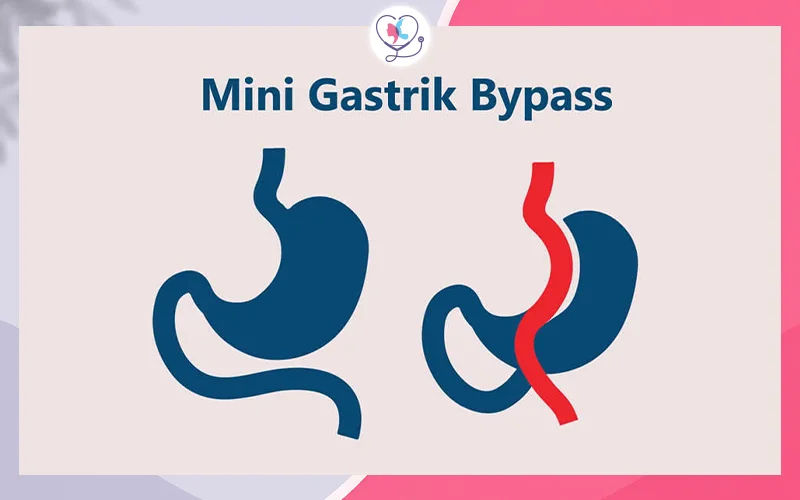 تحويل المسار المصغر (Mini Gastric Bypass)