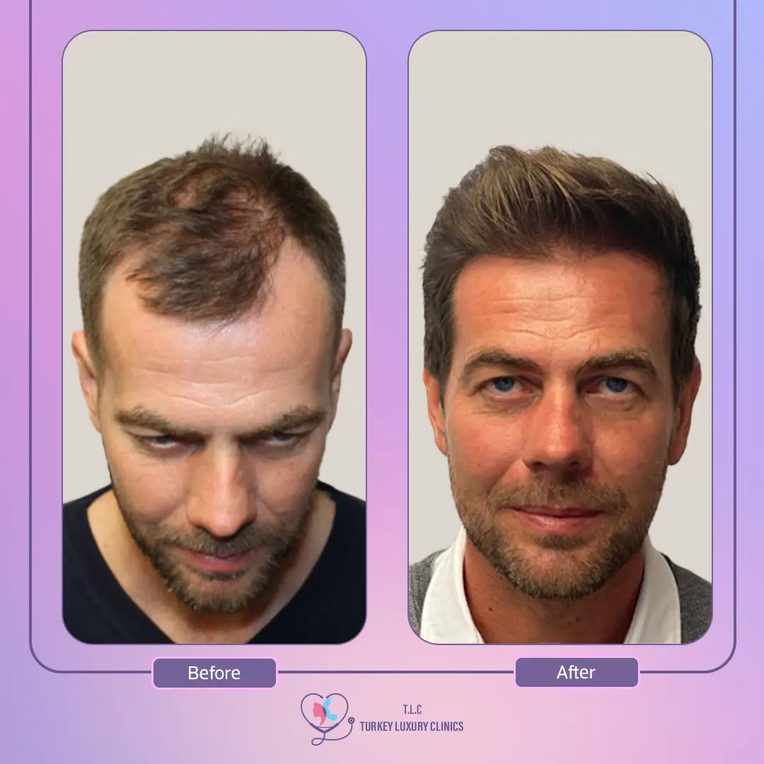 هل هناك بديلٌ عن زراعة الشعر؟