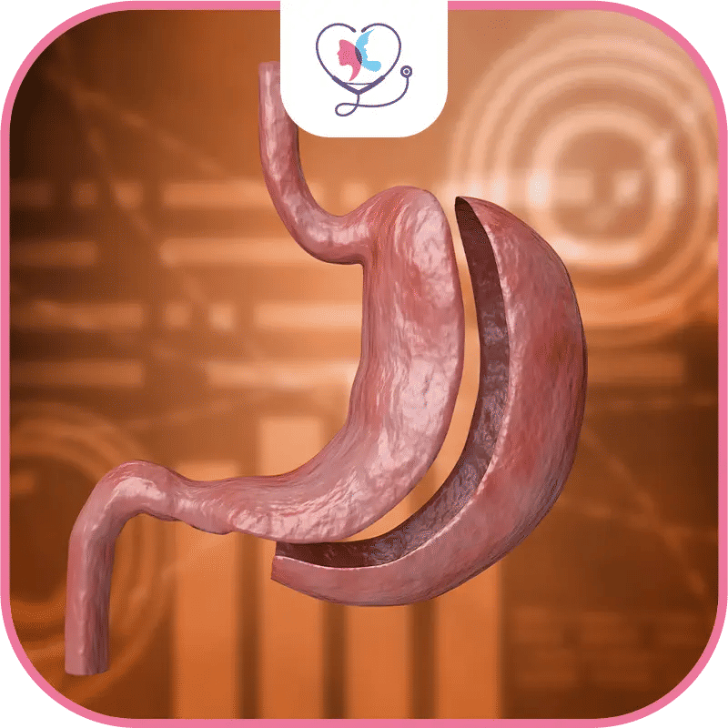 sleeve-gastrectomie-étape-par-étape-image-1772041624526