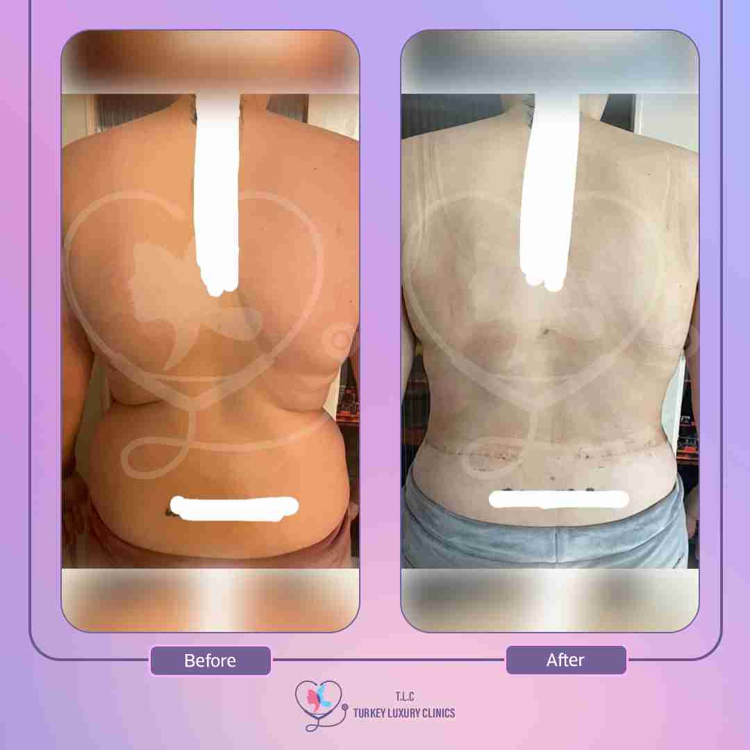 التعافي بعد عملية شد الظهر الأفقي