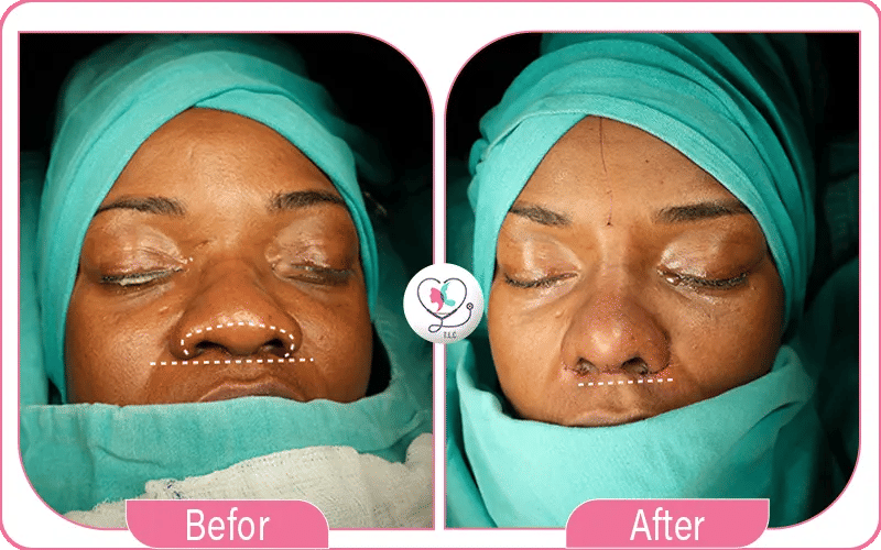 المرشحون لإجراء عملية تجميل الأنف الأفطس