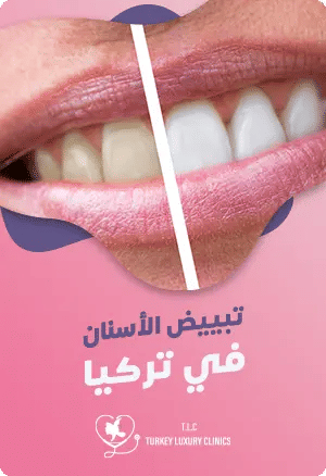 تبييض الأسنان في تركياfeatured image