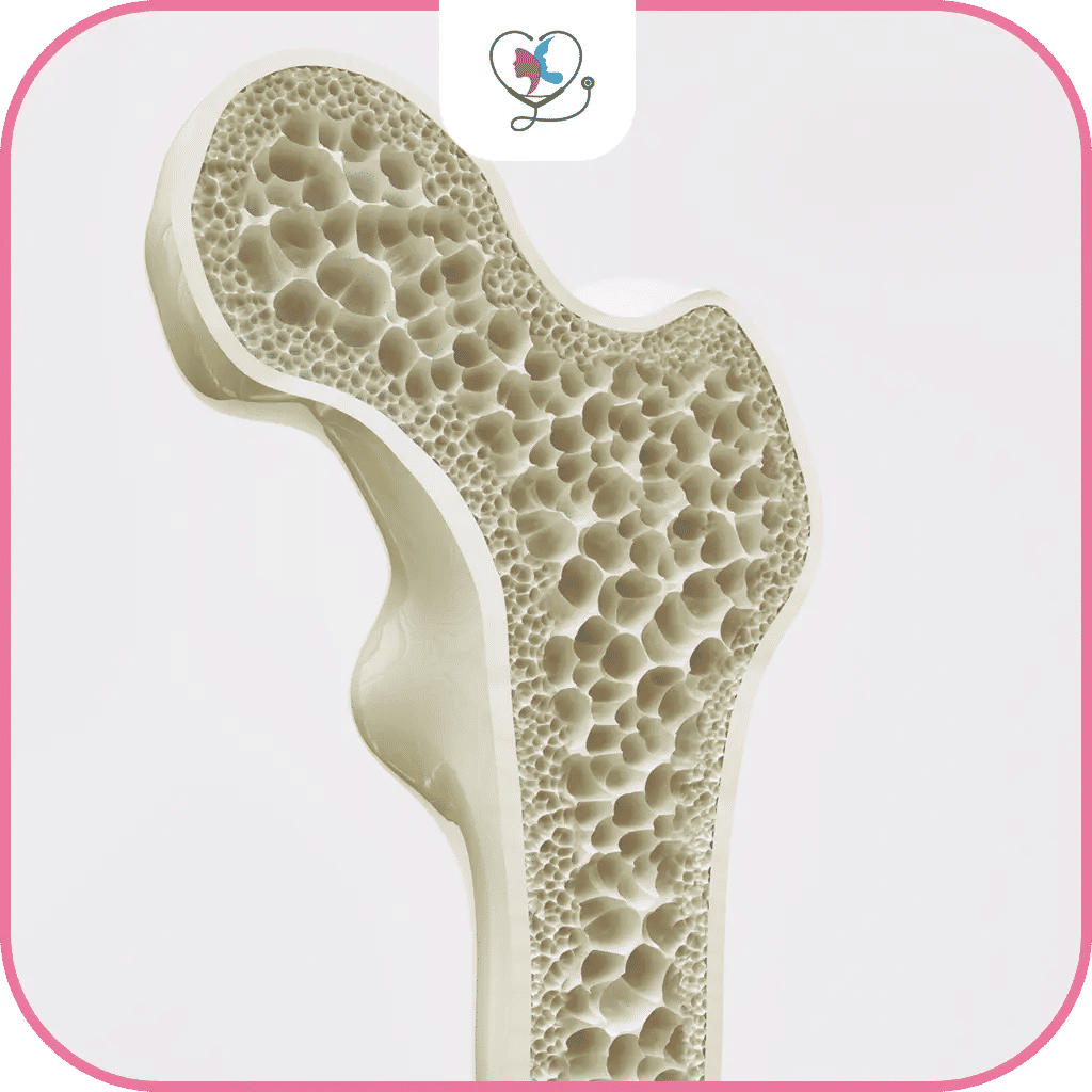 تعريف هشاشة العظام