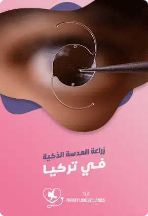 زراعة العدسة الذكية في تركياfeatured image