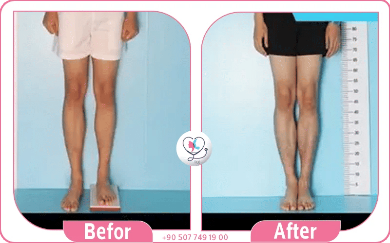 بنتي رجل أطول من رجل: ماذا أفعل؟