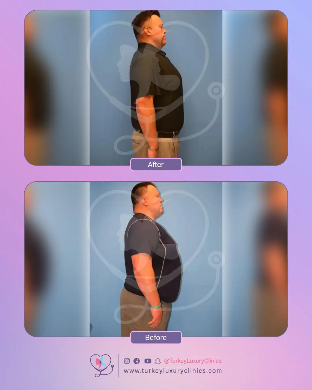 Bypass Turquie : Prix tout inclus - Chirurgien expert & suivi