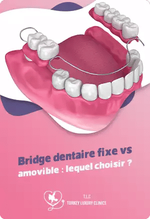 Bridge dentaire fixe vs amovible : lequel choisir ?