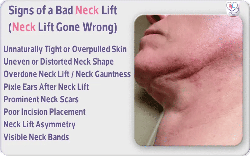 Signs of a Bad Neck Lift (Neck Lift Gone Wrong)