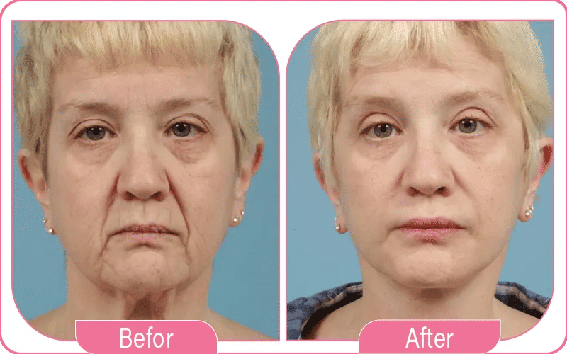 injection botox avant après