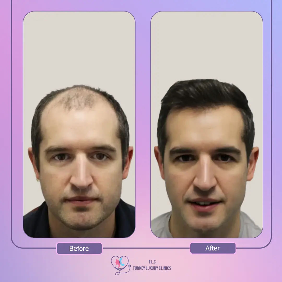 نتائج زراعة الشعر بالصور