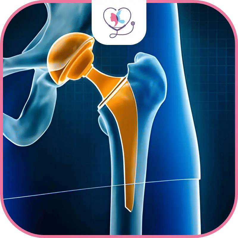 تكلفة استبدال مفصل الورك 2026