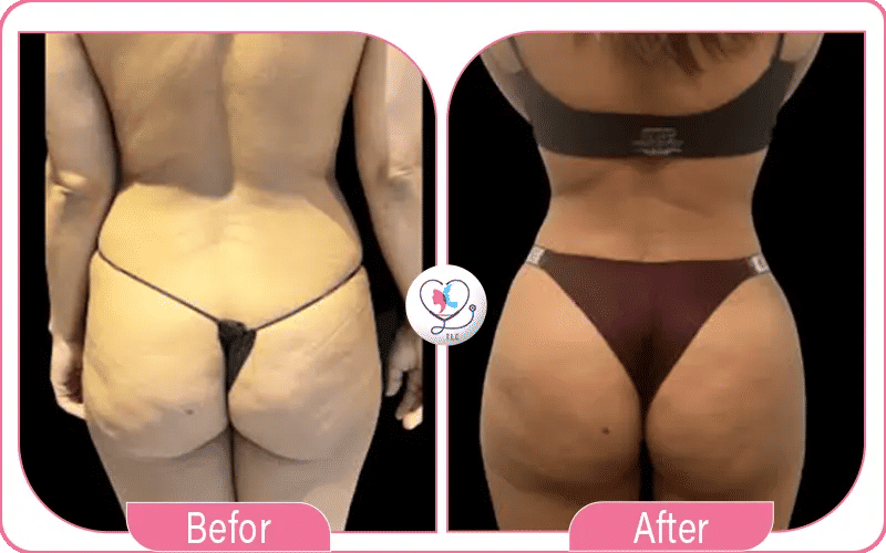 Mommy Makeover with BBL Before and After