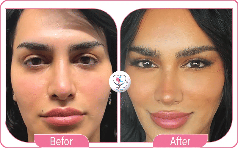 ما هي عملية عيون القطة؟