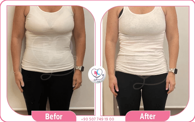 ابر المنجارو للتنحيف