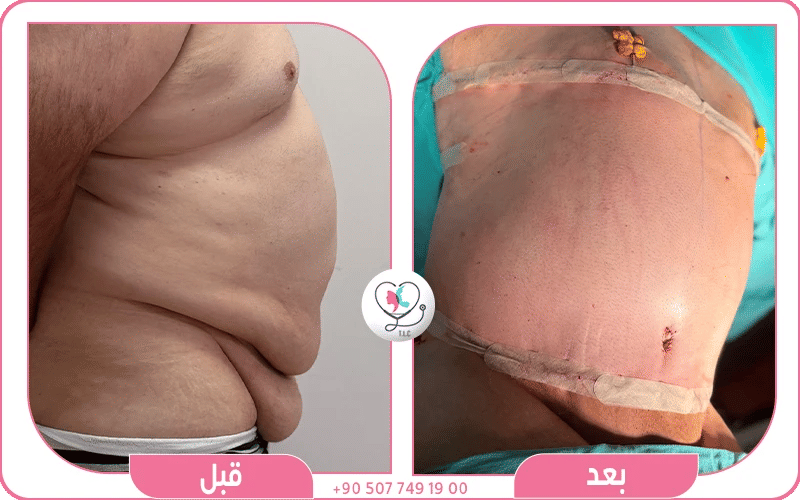 عملية شد البطن
