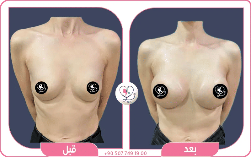 تجارب ناجحة لتكبير الثدي: تكبير الثدي بالسيليكون