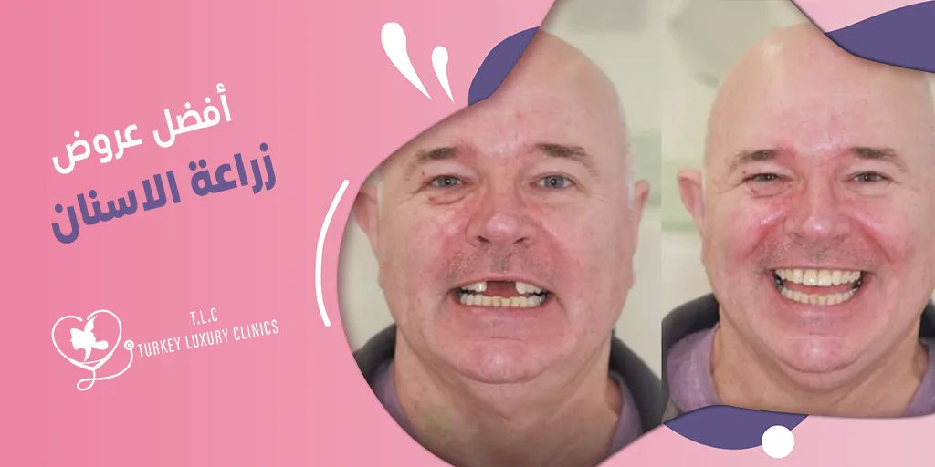 عروض زراعة الاسنان: تركيا والسعودية ودول أخرى مقارنة 2026