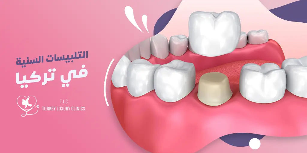 تلبيس الأسنان في تركيا