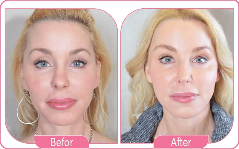 Lipofilling visage ou acide hyaluronique : Que choisir ?