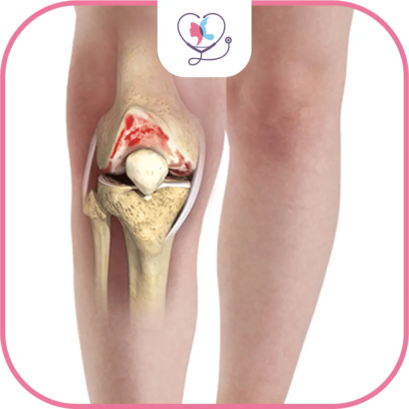 What is Knee Arthritis?