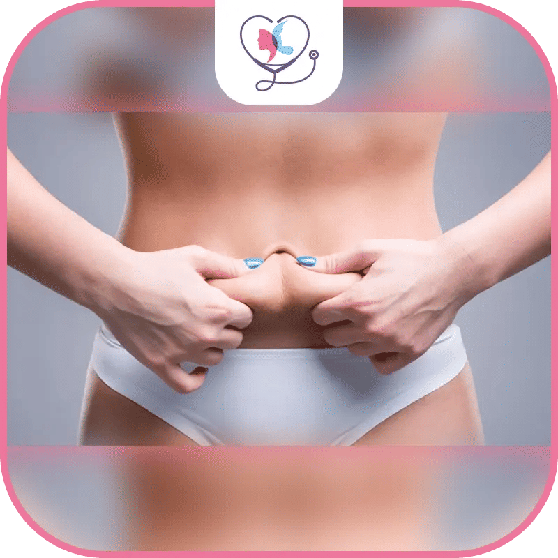 عملية شد البطن المصغرة