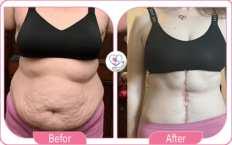 Tummy Tuck Changes During Week 3 vs. Week 1–2