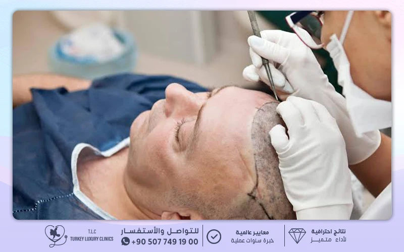 عملية زراعة الشعر يوم العملية