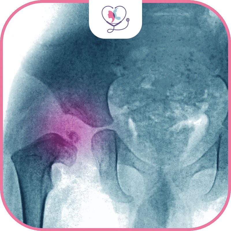 تكلفة جراحة العظام للأطفال في تركيا