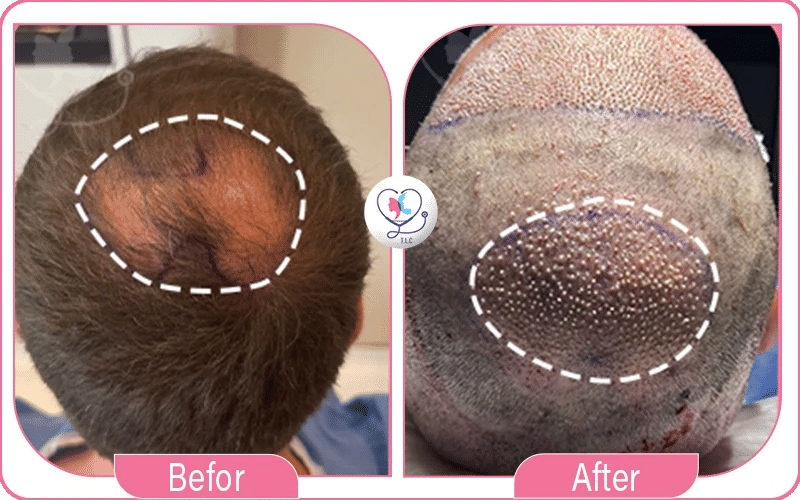 ما هي تكلفة زراعة الشعر في تركيا؟