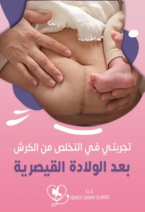 تجربتي في التخلص من الكرش بعد الولادة القيصرية: الحل شد البطن