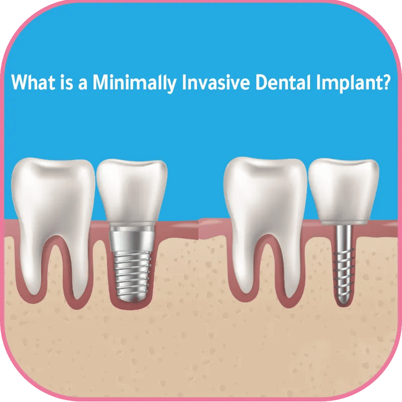 What is a Minimally Invasive Dental Implant?