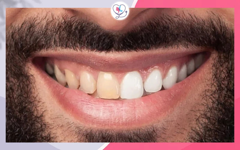 تصحيح مظهر الأسنان المشوهة أو التي فقدت لونها الطبيعيّ