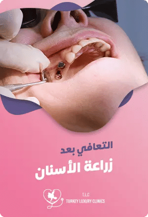 التعافي بعد زراعة الأسنانfeatured image