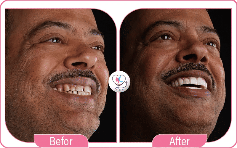 Porcelain Veneers in Turkey Before & After