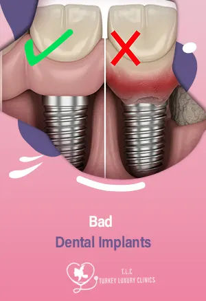 Bad Dental Implants: Causes, Risks, and How to Fix Them
