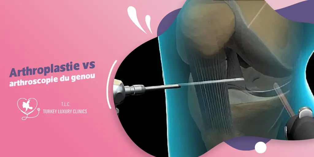 Arthroplastie vs arthroscopie du genou