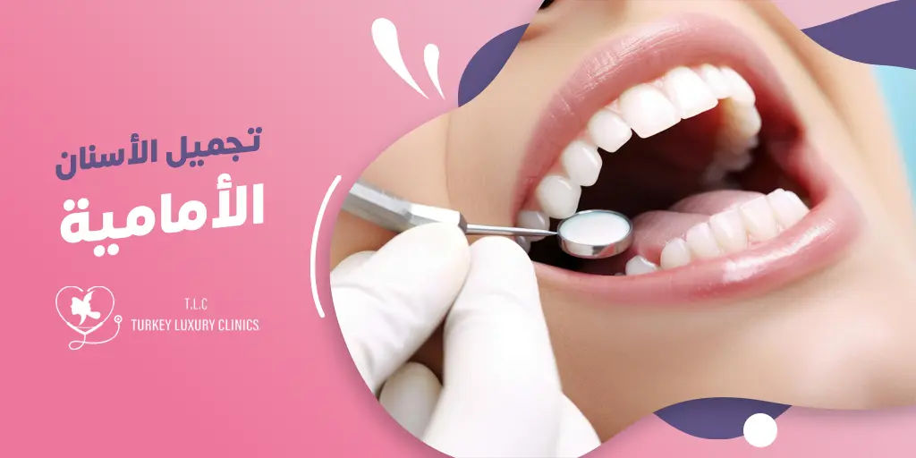 تجميل الأسنان الأمامية 