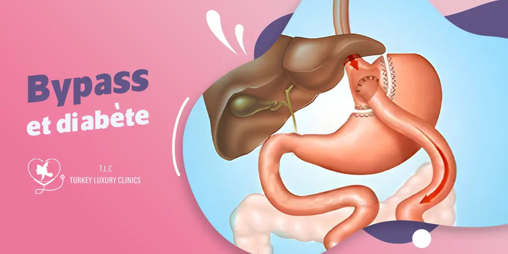 Bypass et diabète : Un traitement efficace pour le contrôle du diabète